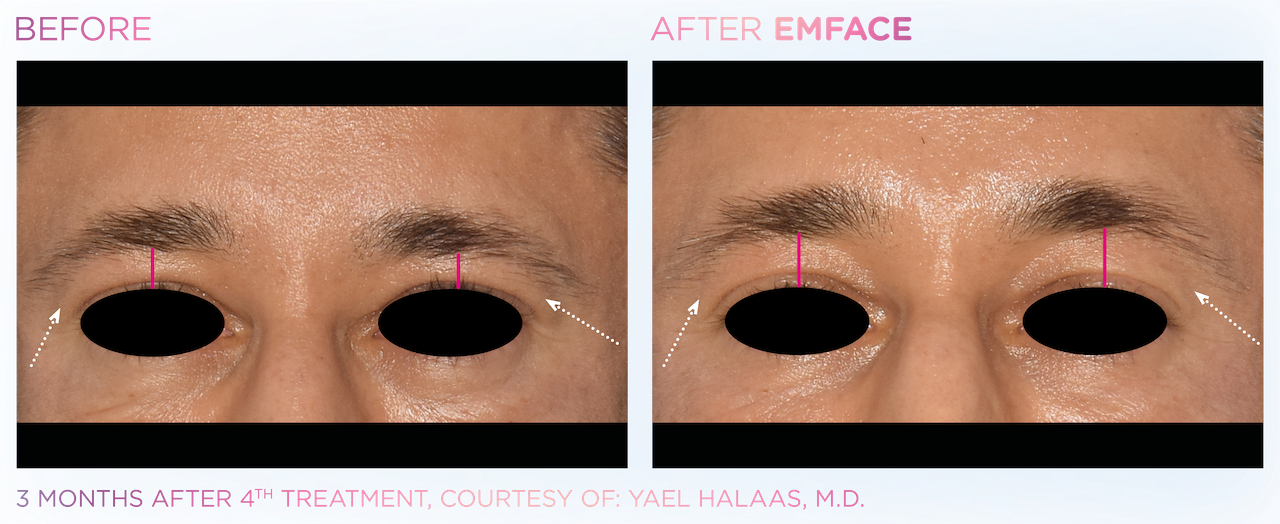 male brow lift example